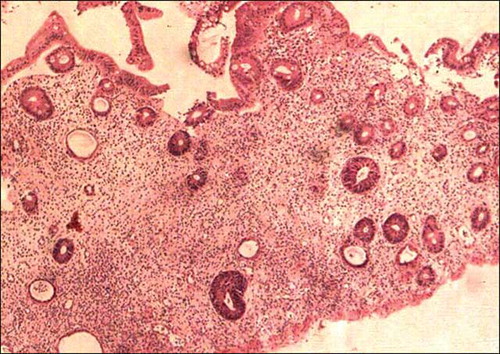 Figure 6.  Colonic mucosal biopsy showing significant reduction in crypts, consistent with MMF-related toxic changes, hematoxylin eosin stain, 200×.