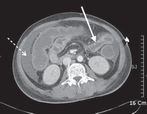 Fig. 1. Non-enhanced abdominal CT scan showed ascites in abdominal cavity (dotted arrow) and diffuse bowel wall swelling (solid arrow).