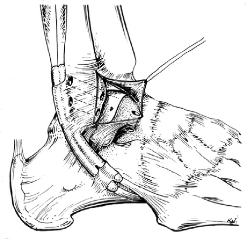 Figure 2. Drill holes are made in the distal fibula (2×) and the talus.