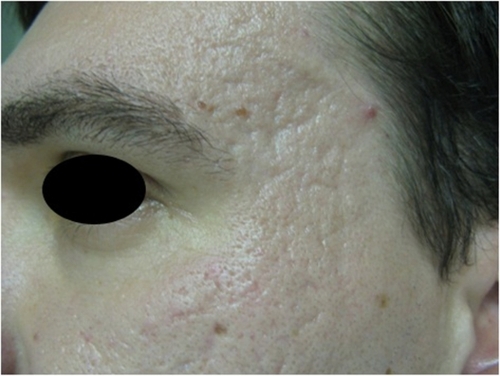 Figure 2A Fractional CO2 laser for acne scars before treatment.