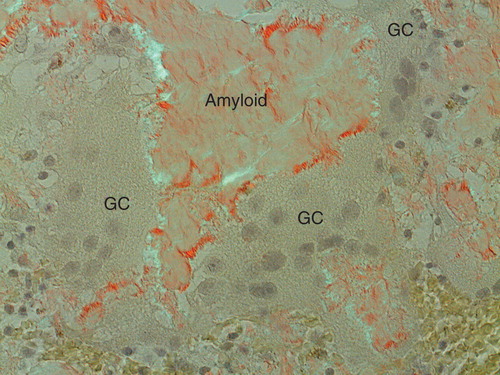 Figure 4. Amyloid adjacent to giant cells (GC). An organization of amyloid fibrils is apparent when in contact with giant cells. This organization is interpreted as assemblage of protein, probably after some modification, into fibrils on or at the surface of the cells. Congo red stained section in polarized light with crossed polars.