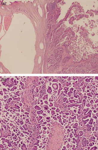 Figure 1.  A – low power view of normal cervix on the left and endocervical adenocarcinoma on the right. B – papillary serous adenocarcinoma of uterine cervix with psamomma body formation.