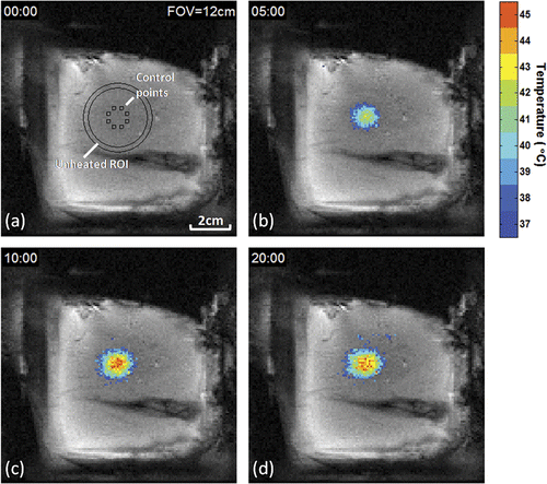Figure 3. Evolution of temperature distribution during MRI-controlled focused ultrasound heating of a 10 mm diameter region. Control ROIs, circular unheated ROI, and temperatures greater than 37°C are overlaid on coronal FSPGR magnitude images after (a) 0, (b) 5, (c) 10, and (d) 20 minutes of heating.