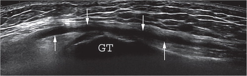 Figure 1. Example of an ultrasound finding classified as a fluid-filled pseudotumor. Lateral image showing a thin-walled hypoechoic fluid collection (arrows) in the greater trochanteric region under the deep fascia. GT: greater trochanter.
