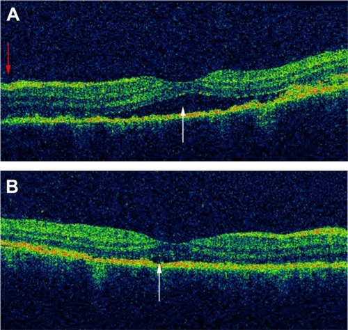 Figure 12 OCT scan of the macula of a patient in the acute phase of VKHD before and after starting corticosteroid treatment.