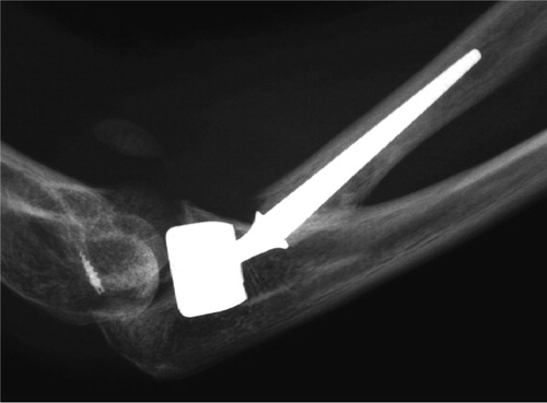 Figure 2. Lateral radiograph of the bipolar radial head prosthesis: case 1 at 12-month follow-up. Note the anchor used in the LCL repair.