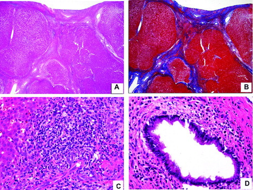 Figure 1.  Composite photomicrograph. A&B were taken from a patient with autoimmune hepatitis and C&D from another patient with primary sclerosing cholangitis. A. H&E-stained slide with a 4× lens demonstrates a cirrhotic liver with bands of bridging fibrosis and regenerative nodules. B. Trichrome-stained liver with a 4× lens taken at the same area as the H&E-stained section from A highlighting the bridging fibrosis in blue. C. H&E-stained slide with a 40× lens showing extensive chronic inflammation extending beyond the limiting plate and a few compressed bile ducts. D. H&E-stained slide with a 40× lens depicts moderate chronic inflammation surrounding the bile duct.