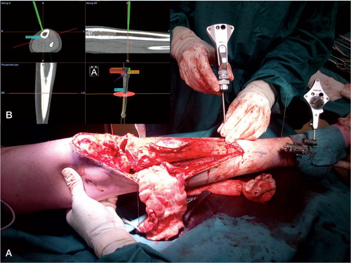 Figure 2. A. Tracker rigidly attached to the tibia using percutaneous pins. Visible is the pointer tool being used for planning the distal resection plane around a Ewing sarcoma. The corresponding CAS view can be seen in the image. B. Surgical plan: a dome-shaped proximal resection very close to the tibial plateau, distal resection, and then reconstruction with a hybrid, allogenic and autogenic massive allograft.