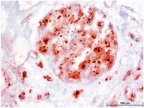 Figure 3. Light microscopy: Oil red O staining showed large amounts of red droplets in the thrombus-like substances in the renal specimen.