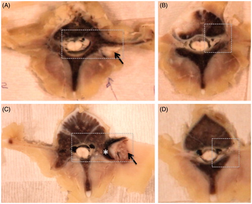 Figure 6. Examples of gross pathology from the acute experiment 2 and subacute experiment 1. Ablation in muscle tissue (black arrow) appears as a paler area in the acute case (A, B) and the area surrounded by the brown rim in the subacute case (C, D). The brown rim of haemorrhage is apparent in the superficial region of the bone (asterisk) in the subacute case (C). The nerve roots, superior to the ablations, appear normal on gross pathology (B, D). The dashed box shows the region selected for histological analysis. The subacute gross pathology image corresponds to the follow-up images in Figure 4.