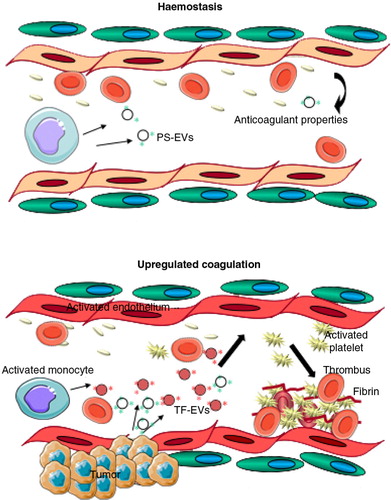 Fig. 4.  EVs in coagulation.Haemostasis: Originating from various sources (monocytes, endothelial cells, platelets), procoagulant (tissue factor (TF)-EVs and phosphatidylserine (PS)-bearing EVs) and anticoagulant, as well as pro-fibrinolytic EVs may circulate at low levels in normal, healthy blood, contributing to the maintenance of the homeostatic balance in blood coagulation. Up-regulated coagulation or thrombosis: Various clinical conditions (cancer, cardiovascular diseases, inflammation, diabetes, sepsis and others) may trigger the coagulation system, activating circulating monocytes and platelets, making endothelial cells procoagulant and resulting in increased generation of procoagulant EVs, particularly TF–EVs, thus leading to a hypercoagulable condition with thrombotic events, hallmarked with fibrin formation and platelet entrapment (thrombus formation).