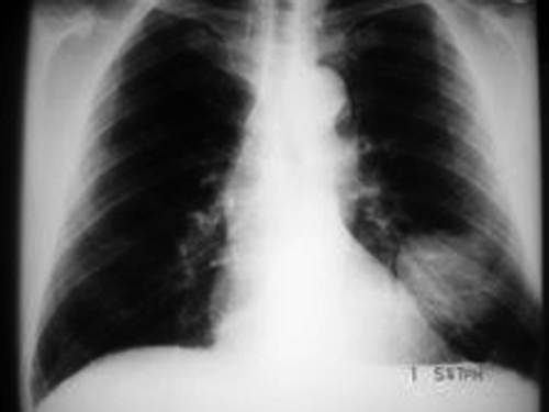 Figure 3.  CXR showing rounded peripheral left lung lesion.
