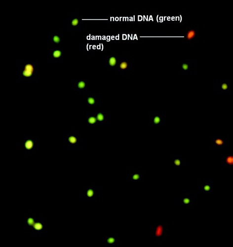 Figure 1.  Assessment of human sperm DNA integrity by acridine orange staining (40X). DNA integrity was assessed using acridine orange staining following sperm fixation. The percentage of green (normal DNA integrity) and orange red (abnormal DNA integrity) spermatozoa per 200 spermatozoa in each sample was calculated. An abnormal integrity of sperm DNA was considered as more that 30% denaturation (orange-red).