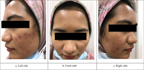 Figure 2. Photo of the face 1 month after RFM treatment. Uniform papular eruptions appeared in the forehead area and hyperpigmented macules appeared with tram track pattern in the zygomatic arch area on the right side.