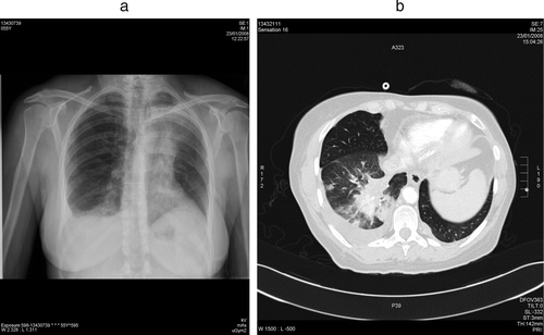 Figure 2.  Tumor progression (“flare-up”) documented by chest radiograph (a) and chest CT scan (b) at admission (6 days after discontinuation of sunitinib for surgical intervention) (23-01-2008).