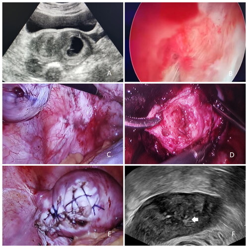 Figure 1. (A) Transvaginal ultrasound showing a septum inside the uterus and the gestational sac in the blind cavity. (B) Hysteroscopic appearance of a unicornuate uterus. (C) Violet-blue nodules are observed on the surface of the left uterosacral ligament. (D) The blind cavity was confirmed using forceps to explore. (E) The appearance of the uterus after salpingectomy and elimination of the blind cavity. (F) Transvaginal ultrasound showing the uterus with one cavity with scar (white arrow) formed in the myometrium of the former blind cavity 5 months later.