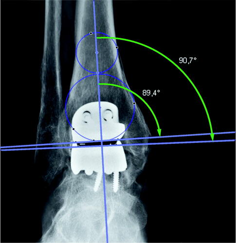 Figure 1. The center of the tibial plateau was determined by drawing a circle within the medial and lateral cortex. A second circle fit inside the distal tibia between the medial and lateral cortex and touched the plafond distally. The mechanical axis goes through both the center of the distal tibia and the center of the talus. A line marking the tibial plateau/distal tibial component intersected the mechanical axis for the medial distal tibial (MDTA; small arch) angle. The medial talus (large arch) angle was measured from a transecting line, tracing the superior talus/talar component. An angle above 90° is a valgus angle and below 90° is a varus angle.