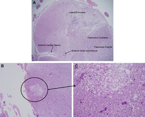 Figure 2. Histopathology of cervical spine demonstrating involvement of lateral funiculus.