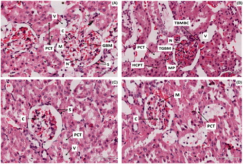 Figure 3. Photomicrographs (H and E) illustrating the effects of transdermally delivered insulin on the morphology of the kidney in STZ-induced diabetic rats. Photomicrograph (A) represents the normal glomerulus of the untreated non-diabetic rat kidney section showing normal glomerular basement membrane (GMB), glomerular capillaries (C), nuclei (N), proximal convoluted tubule (PCT), mesangium (M), veins (V) and squamous cells (S). Photomicrograph (B) represents the injured glomerulus of the STZ-diabetic rat showing irregular glomerular capillaries, thickened glomerular basement membrane (TGBM), thickened basement membrane of the Bowmans capsule (TBMBC), hypercellularity of the proximal tubules (HPT) and mesangial proliferation (MP). Photomicrograph (C) represents the glomerulus of the transdermal insulin treated rat kidney section showing irregular glomerular capillaries but no basement membrane thickening and mesangial proliferation. Photomicrograph (D) represents the glomerulus of the subcutaneous insulin treated rat kidney section showing irregular glomerular capillaries but no basement membrane thickening (Mag 35 × 100 μm).