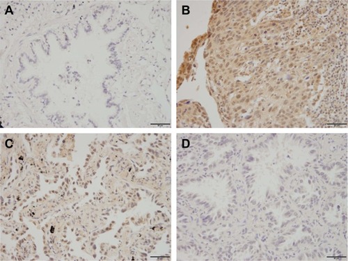 Figure 1 Expression pattern of TRIM32 in NSCLC.