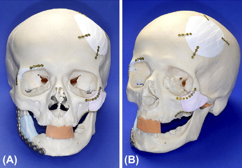 Figure 9. (A) General view of the implant-bearing skull. Implants are fixed with miniplates for mandibular defect. (B) The drill holes for screw insertion were made after positioning of the implants using a common bone drill. Adapted from reference (Citation157) with permission of Journal of Cranio-Maxillofacial Surgery, Elsevier, Copyright 2010.