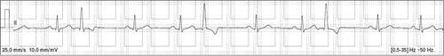 Figure 1. Example of PVCs found in a routine electrocardiography.