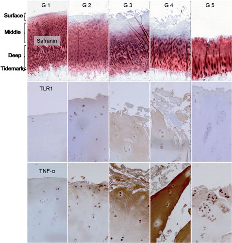 Figure 6. Safranin O, TLR1, and TNF-α staining of OARSI-graded osteoarthritis samples (grades G1–G5). TLR2 and TLR9 immunostaining was rather similar to that of TLR1 and is shown in Supplementary figure. Surface (tangential, gliding), middle (transient), and deep (radial) zones are marked, and also tide mark (between cartilage and calcified cartilage) and subchondral bone. The safranin O microphotographs are panoramic images, constructed from several microphotographs to provide an overall view of all zones in one image. Magnification 100×.