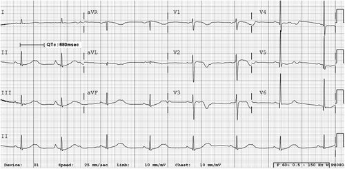 Figure 1. Oxaliplatin-induced abnormal long QT syndrome. QTc is 680 ms.