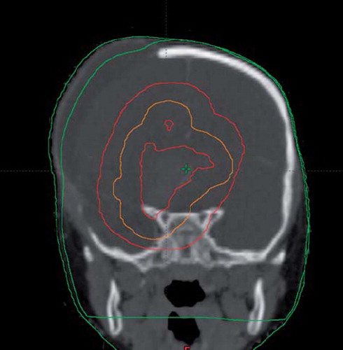 Figure 3. Planning CT with oedema present in right lateral region.