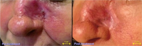Figure 2 Actinic lesion with a wide erythematous area: a case–control study. The same case–control study 7 days after beginning of T1 treatment.