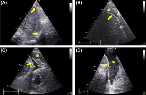 Figure 2. Chest ultrasound with examples of pleural effusion. A: absent, B: small (only in the costophrenic angle), C: moderate, D: large. Double arrows show the measurement of pleural effusion. Thick arrows indicate the diaphragm. X: lung (in B air-filled, in C and D consolidated). *pleural effusion.