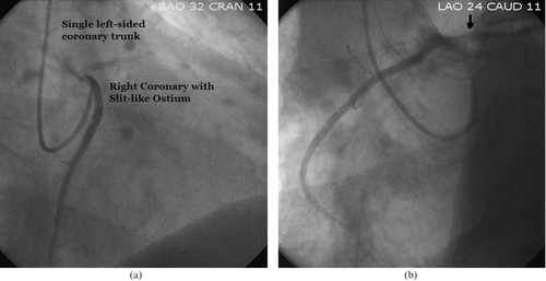 Figure 1. (a) Right‐anterior‐oblique coronary angiography of RCA, demonstrating a ‘slit‐like’ ostium. (b) Left‐anterior‐oblique coronary angiography of RCA, revealing common origin with left main trunk (arrow).
