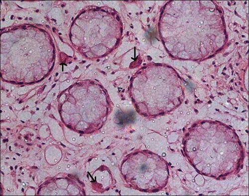 Figure 4.  Colonic mucosal biopsy showing CMV inclusions in mucosal capillary endothelium (arrow), hematoxylin eosin stain, 400×.