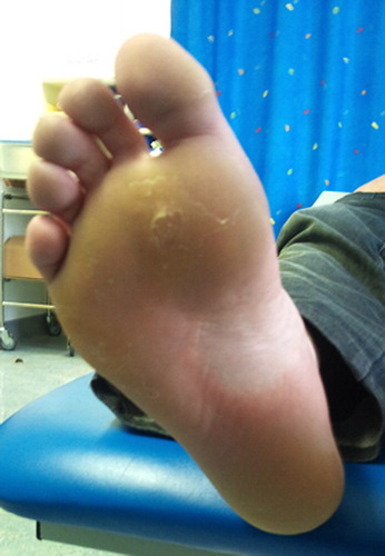 Figure 1. Resolving hyperkeratosis of plantar surface of right foot (similar findings in left foot, not shown).