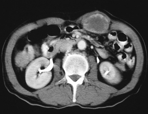 Figure 1.  Post contrast axial CT scan shows hypodense with peripheral contrast enhancement mass in the left rectus muscle.
