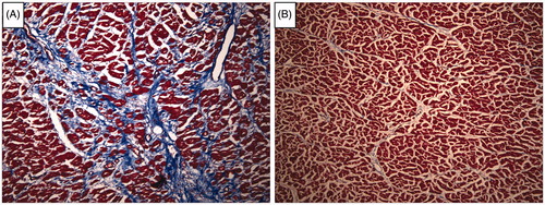 Figure 1. Fibrosis of the left ventricle in individuals with and without exogenous vitamin D exposure. Representative images of left ventricle from patients with (A) and without (B) exogenous vitamin D exposure. Left ventricle sections were paraffin embedded, sectioned at 5 µm and trichrome stained using standard techniques and visualized at 100× magnification.