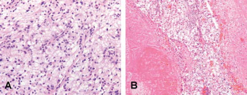 Figure 3. Histology of the primary tumour (A) (H&E, 200×) and the caval vein thrombus which contains vital tumour cells of clear cell histology (B) (H&E, 100×).