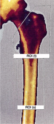 Figure 3. Placement of the regions of interest (ROI) on the femur DEXA scan: the trochanteric region (ROI(t)) and the shaft region (ROI(s)).