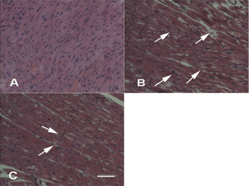 Figure 6.  Effects of ginsenoside Rb3 on pathological changes of left ventricle in myocardial ischemia-reperfusion injury in rats. (H&E, 400×). (A) Control group showed clear integrity of myocardial cell membrane, and no inflammatory cell infiltration. (B) Myocardial ischemia-reperfusion group showed widespread myocardial structure disorder and subendocardial necrosis, which is related to infiltration with neutrophil granulocytes and myofibrillar fracture. (C) Ginsenoside Rb3 group showed mild necrosis and less infiltration of inflammatory cells. Bar = 400 μm.