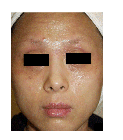 Figure 1. Active lesions of chronic AD, brownish pigmented patches, coarse and fine wrinkles, and alopecic patches on both eyebrows are noted.
