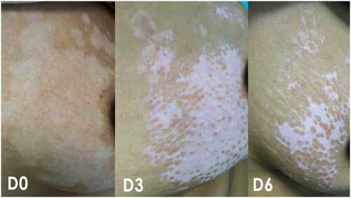 Figure 1. The repigmentation in the trunk (breast) of a female patient after 3 months and 6 months of treatment with calcipotriol/betamethasone cream (combined with VBUVB).
