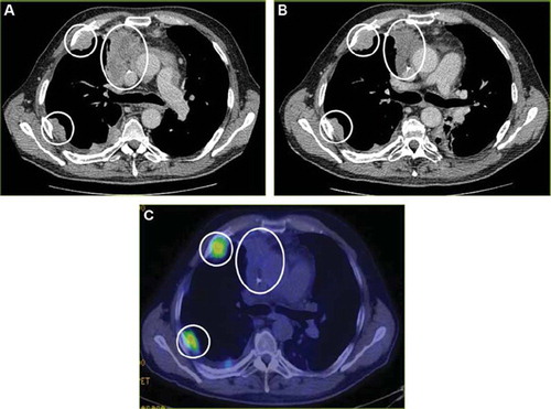 Figure 4. (A) Transverse CT image from March 17, 2009 in a 59-year-old man shows a primary tumor in the right upper lobe, as well as two metastases in the right thoracic wall (circles), but without any further metastasis. (B) A CT scan after four months of study treatment, July 21, 2009, demonstrates stable disease without any additional lesions. (C) 18F-FDG-PET scan from July 15, 2009 shows no uptake of 18F-FDG in the primary tumor and with a modest uptake in the metastases of the thoracic wall (circles).