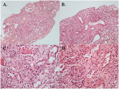Figure 2. (A) Expansion of the interstitium because of inflammatory infiltrates that separate the tubules. The glomeruli appear unremarkable (hematoxylin and eosin [H + E] stain). (B) Large numbers of small lymphocytes expand the renal interstitium (H + E). (C) Leukocyte infiltration of the tubular epithelium (tubulitis) and variable amounts of tubular injury (tubular necrosis, desquamation, degeneration). (D) In addition to the interstitial lymphocytes, plasma cell and sparse eosinophils are observed (H + E).