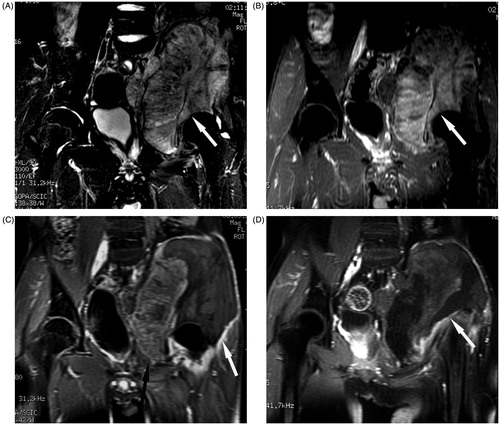 Figure 2. Coronal MR in a 15-year-old boy with osteosarcoma in the left ilium who received palliative HIFU ablation. (A) T2-weighted MR of the tumour (arrow) before HIFU ablation. (B) The tumour showed evident enhancement on T1-weighted contrast-enhanced MR before HIFU ablation. (C) After one HIFU ablation session, the ablation area showed no enhancement (white arrow), the residual tumour (black arrow) still had enhancement. (D) After the second HIFU ablation session, almost the entire tumour showed no enhancement (arrow).