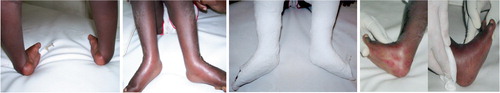 Figure 2. 3-year-old boy before treatment. After 5 casts.The sixth cast. After PAT.