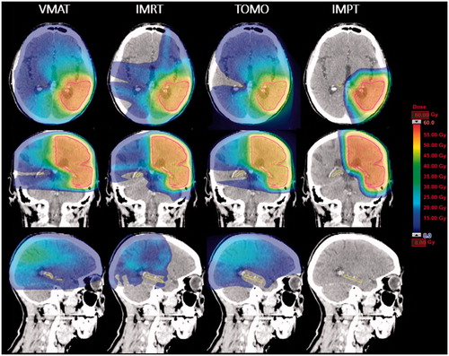 Figure 1. Example of a radiation treatment plans for a patient with a LGG parieto-occipitally in the left hemisphere. The CTV (pink), hippocampus (yellow) and dose distribution (ranging from low dose depicted in blue to high dose in red) are given for the VMAT (A), TOMO (B), IMRT (C) and IMPT (D) treatment plans, in the transverse (upper row), frontal (middle row) and sagittal (lower row) view. Of note is the large low-dose bath when using either of the photon techniques (A–C).