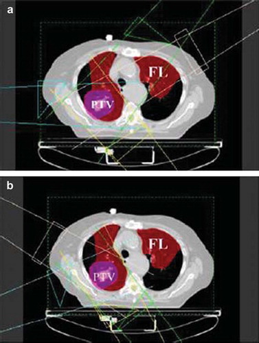 Figure 1. Illustration of the influence of functional imaging on RT planning. Panel a) shows a coplanar plan where functional information was not used. In panel b) functioning lung was preferentially avoided when selecting coplanar beam directions. From Christian et al. [Citation24].