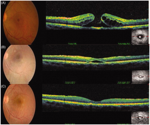 Figure 1. Color fundus photograph and spectral domain–optical coherence tomography (OPKO/OTI Spectral OCT/SLO, OPKO Health, Inc. Miami, Florida) images of the left eye show (A) a full-thickness macular hole before, (B) macular hole closure with subretinal fluid accumulation 1 month after, and (C) complete macular hole closure 4 months after the initiation of interferon alfa-2a therapy.