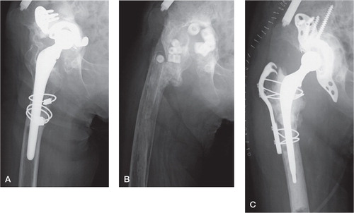 Figure 1. A representative case with unclear infection (case 2). A. Preoperative plain radiograph. B. Plain radiograph after the first operation. Implant removal and antibiotic-loaded hydroxyapatite block replacement were performed. C. Plain radiograph after the second operation.