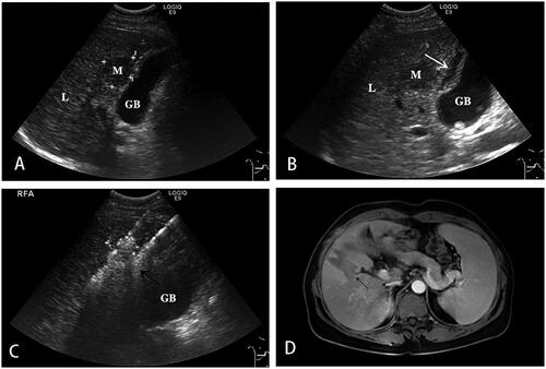 Figure 2. A 44-year-old female with HCC lesions in the S5 of the liver adjacent to the gallbladder underwent ultrasound-guided RFA.A. The lesion in the S5 of the liver adjacent to the gallbladder, with a size of 2.6 × 2.2 cm. B. The gallbladder fossa was filled with saline (white arrow) using the hydrodissection technique. C. RFA (black arrow) with Celon double-needle for the HCC lesions near the gallbladder in the S5. D. 1 month after RFA S5 of the liver (black arrow), MRI showed no enhancement of the ablation lesion. The lesion achieved technical effectiveness.